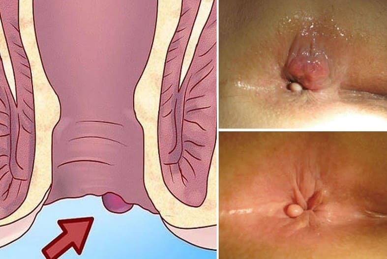 Khái quát chung về trĩ ngoại