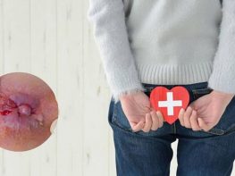 Cách làm teo búi trĩ ngoại