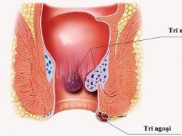 Định nghĩa bệnh trĩ là bệnh gì ?