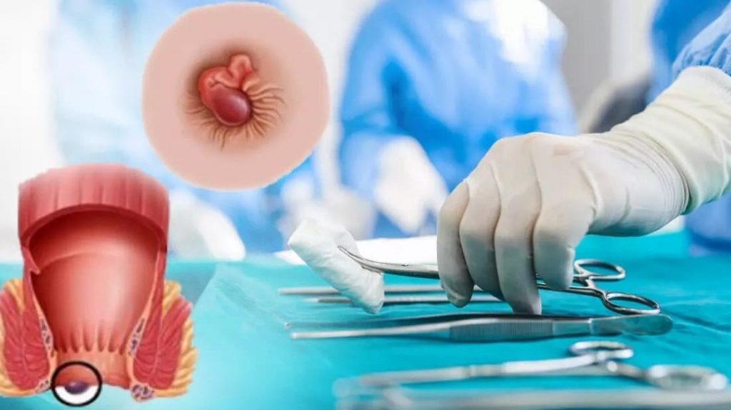 Khi nào người bệnh nên thực hiện cắt trĩ ngoại?
