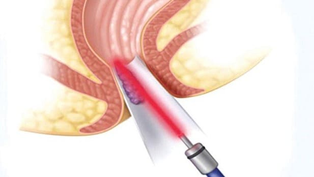 Cắt trĩ ngoại bằng laser