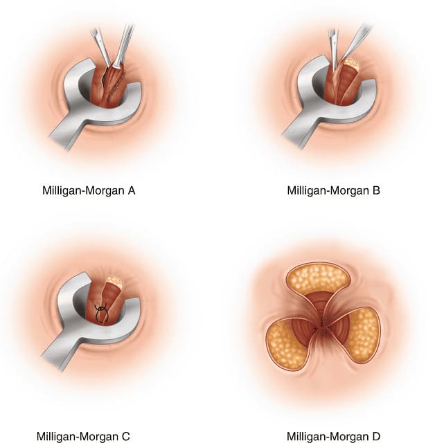 Cắt trĩ ngoại bằng Milligan Morgan