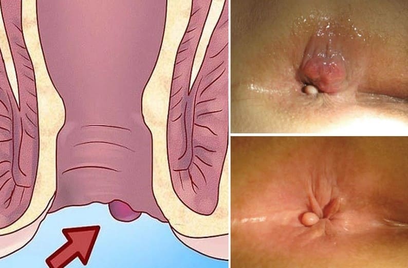 Bạn đã hiểu đúng về căn bệnh trĩ ngoại chưa?
