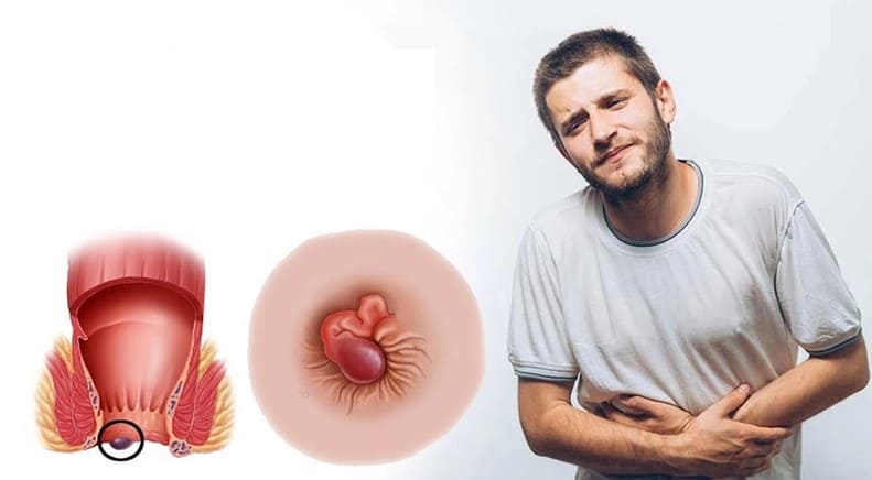 Bệnh trĩ ngoại gây nhiều ảnh hưởng tới người bệnh