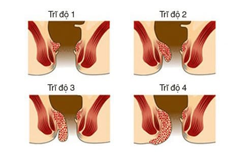 Dấu hiệu nhận biết trĩ nội theo phân độ
