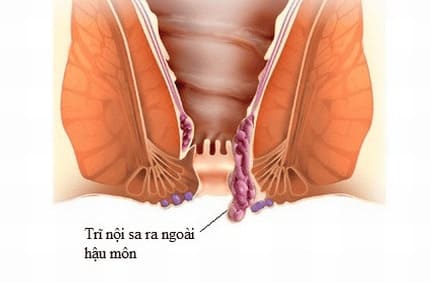 Sa nghẹt hậu môn