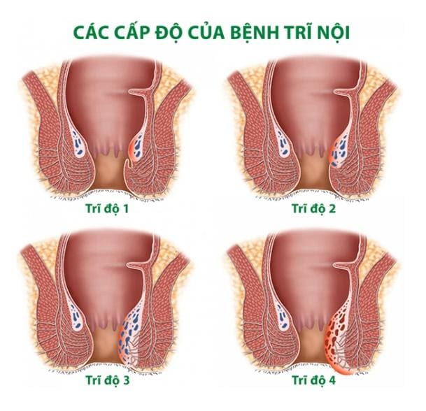 Trĩ nội là gì? Hình ảnh trĩ nội