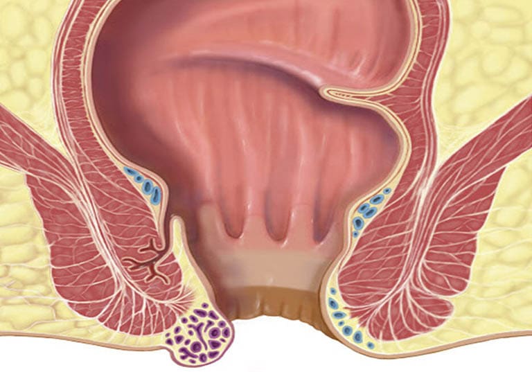 Tổng quan về bệnh trĩ ngoại
