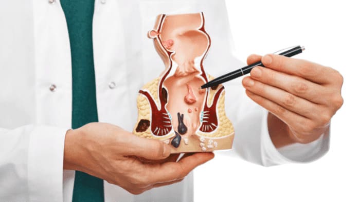 Hạn chế của các mẹo chữa bệnh trĩ ngoại