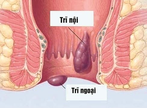 Tổng quan bệnh trĩ ngoại