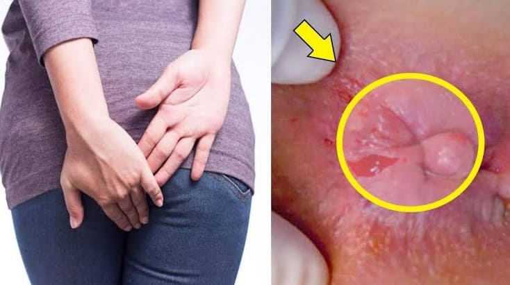 Dấu hiệu nhận biết trĩ ngoại nhẹ?