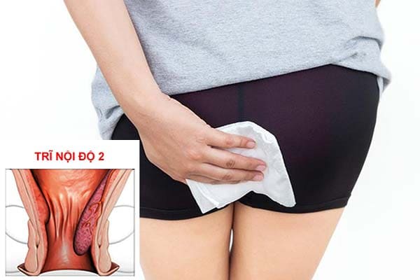 Cấp độ 2 của trĩ nội chảy máu