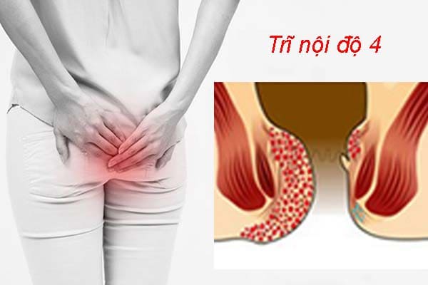 Cấp độ 4 của trĩ nội chảy máu
