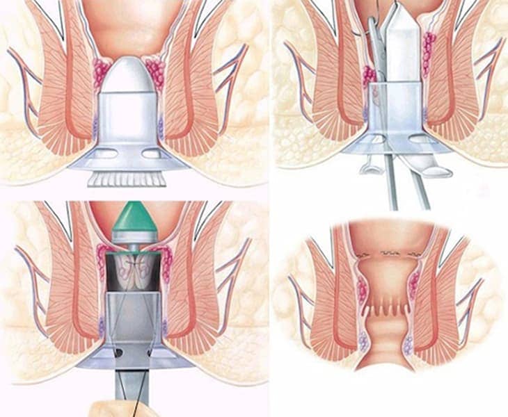 Cắt trĩ nội bằng phương pháp Longo