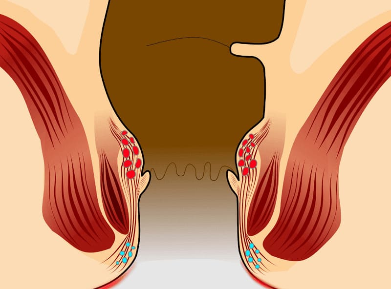 Nhận biết sớm các triệu chứng bệnh trĩ nội ở cấp độ 1
