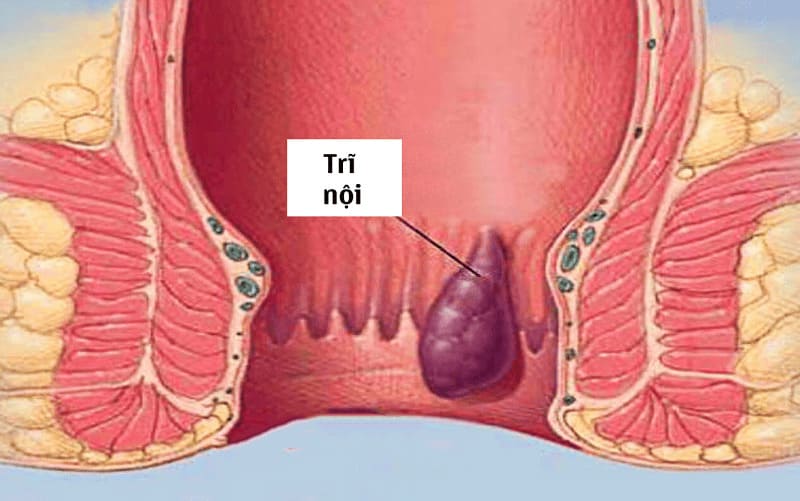 Tổng quan về bệnh trĩ nội