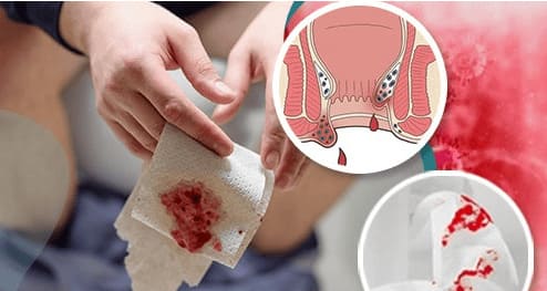 Mức độ ảnh hưởng của trĩ nội độ 2 đến sức khỏe