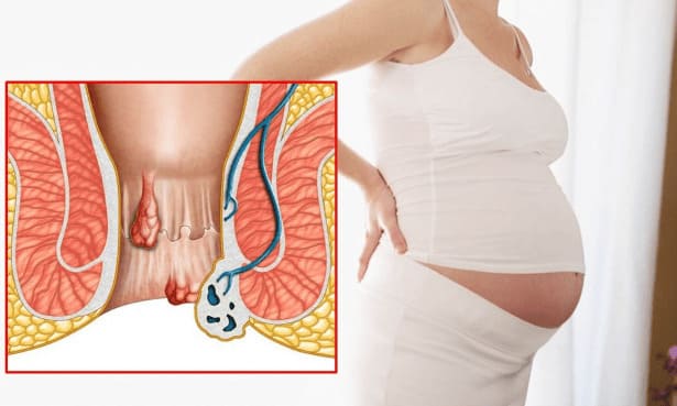 Nguyên nhân khách quan gây bệnh trĩ