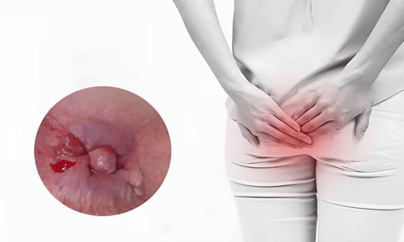 Triệu chứng trĩ nội độ 3: Sa búi trĩ ra ngoài