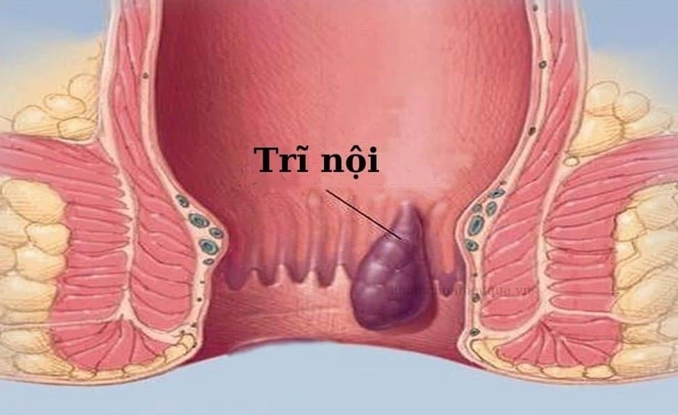 Tổng quan bệnh trĩ nội là gì?