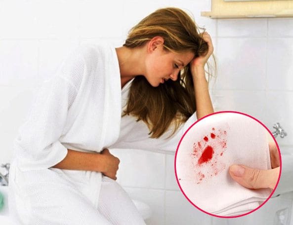 Triệu chứng bị bệnh trĩ