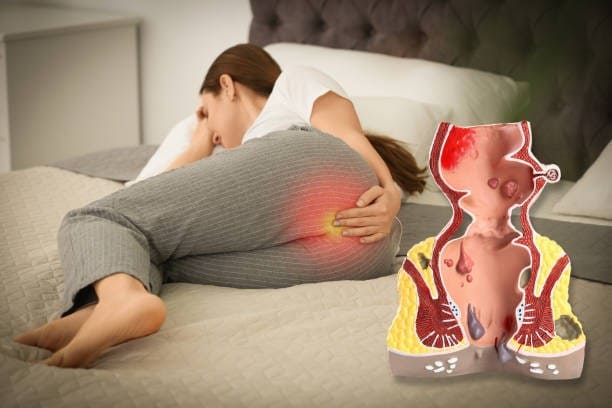 Hiện tượng bị trĩ có ảnh hưởng gì không?
