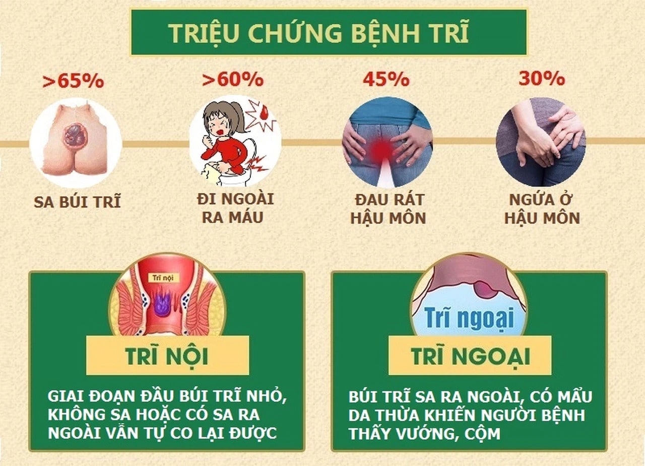 Nhận diện nhanh những triệu chứng bệnh trĩ điển hình