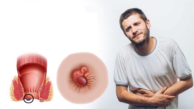 Nhận thấy biểu hiện của bệnh trĩ mọi người phải làm gì ?