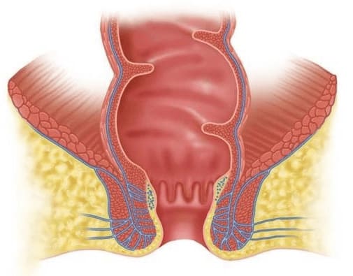 Các yếu tố tăng nguy cơ mắc bệnh trĩ