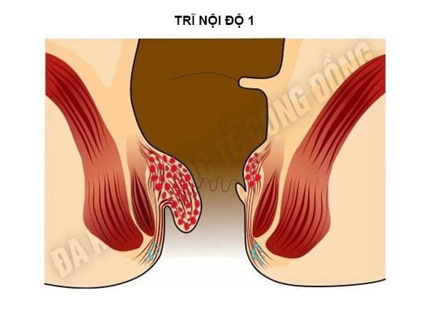 Trĩ nội ở giai đoạn 1