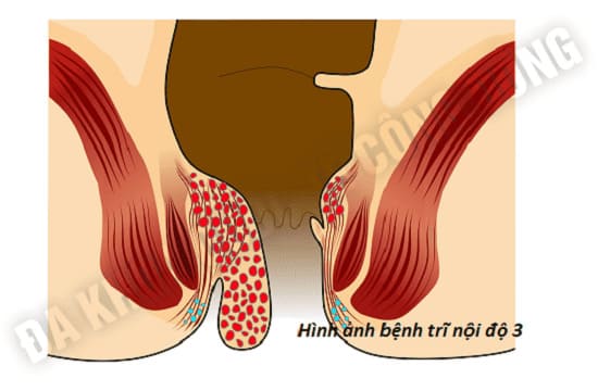 Trĩ nội ở giai đoạn 3