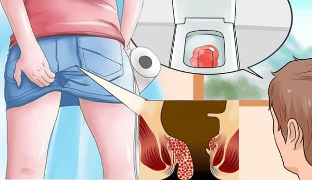 Trĩ nội có nguy hiểm không?