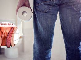 Bệnh trĩ nội độ 4