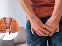 Tiêm xơ trĩ ngoại