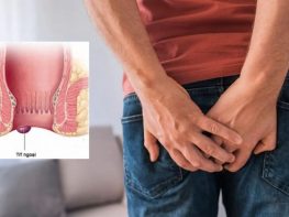 Trĩ ngoại độ 2