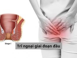 Trĩ ngoại giai đoạn đầu