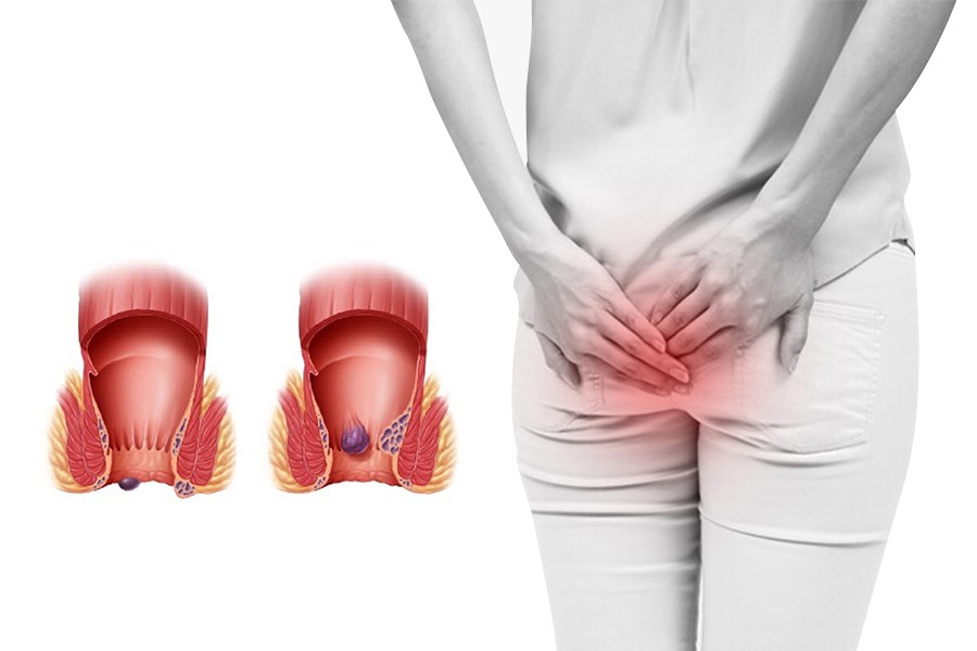 Phải làm gì để ngăn không cho bệnh trĩ xuất hiện?