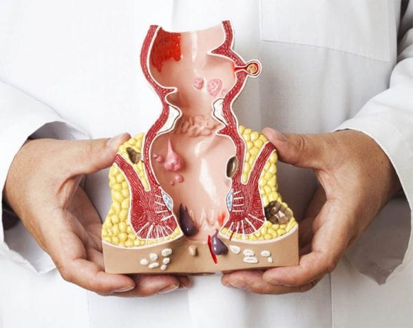 Nguồn gây bệnh trĩ là gì? Ảnh hưởng gì đến việc bệnh trĩ có lây không?
