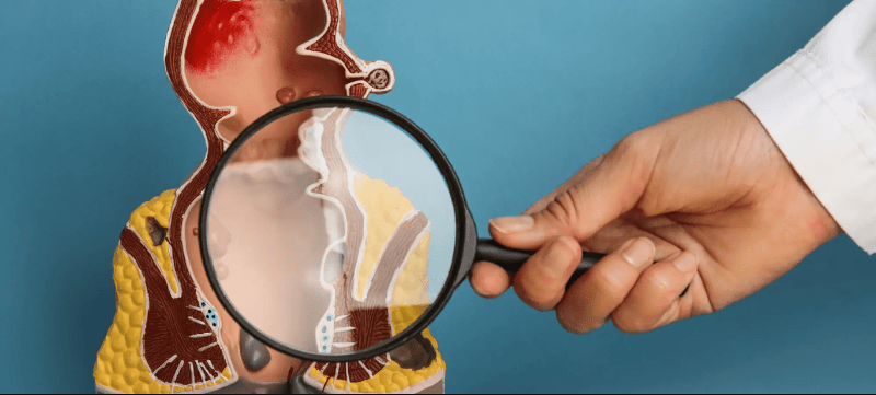 Bệnh trĩ và những điều cần phải biết