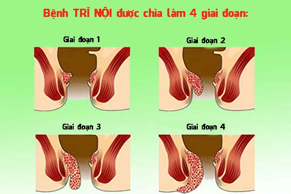Nhận biết chính xác các triệu chứng bệnh trĩ