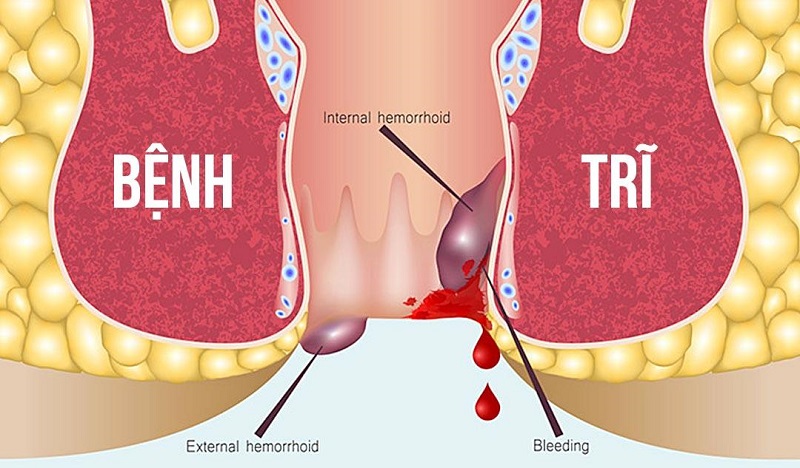 Bệnh trĩ là bệnh lý như thế nào?