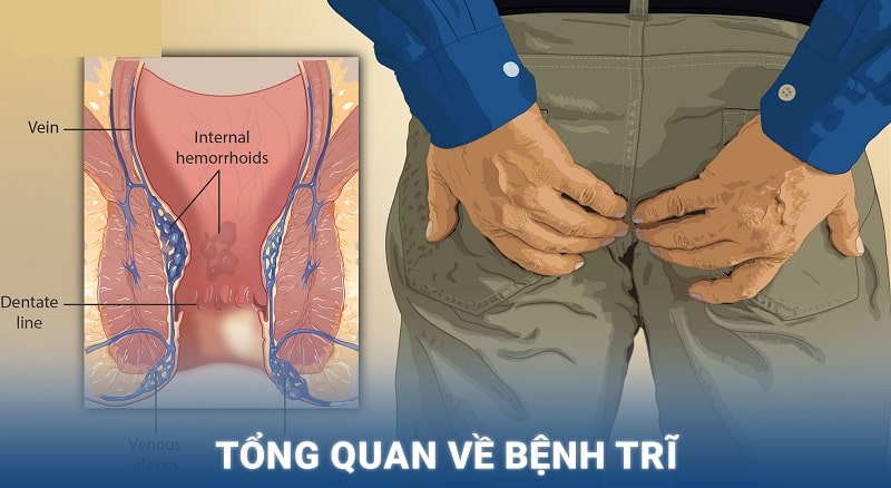 Sơ lược về căn bệnh trĩ