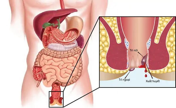 Bệnh trĩ và những thông tin cơ bản