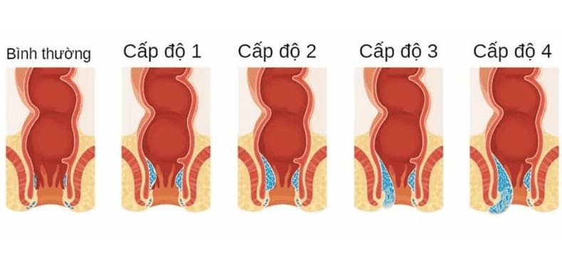 Tổng quan chung về bệnh trĩ nội