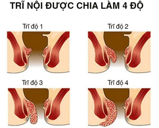Đặc điểm của trĩ nội độ 4