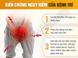 Những biến chứng bệnh trĩ nguy hiểm cho sức khỏe 