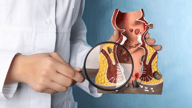 Nguyên nhân dẫn đến tình trạng trĩ ngoại