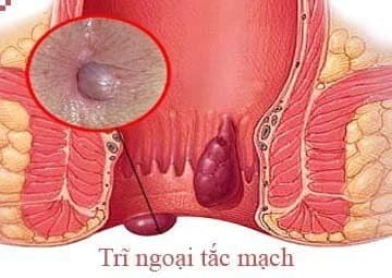 Tắc mạch trĩ