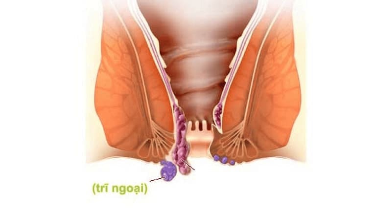 Trĩ ngoại là bệnh lý như thế nào?