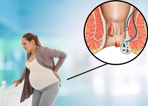 Bệnh trĩ và tình trạng xảy ra ở thai phụ